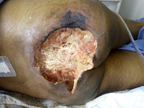 Stage 4 - Catch Me If You Cancer 2025 𝚆𝚊𝚝𝚌𝚑 On Exclusive Channels
